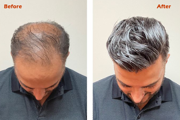 after before